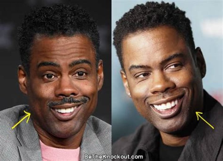 chris rock plastic surgery